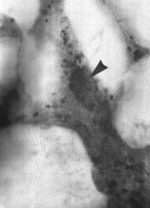 Inclusion body in liver cell due to infectious canine hepatitis